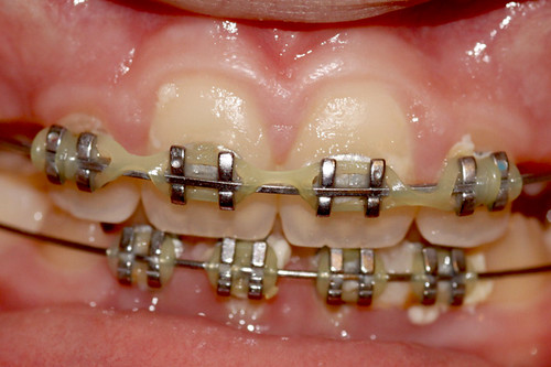 Sonhar com dente caindo: os significados do sonho mais comum do Brasil